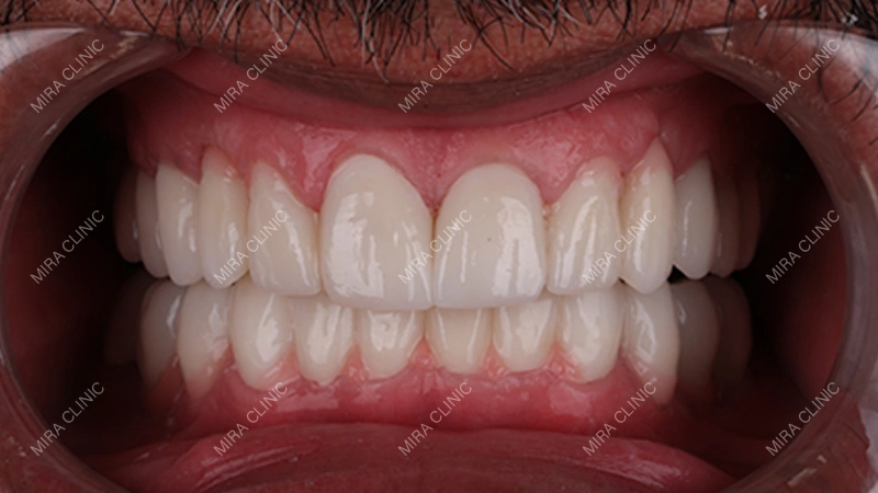 What Happens in Your Mouth When an Implant Bridge Is Placed
